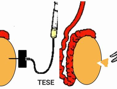 There is a new procedure that could restore male fertility by reimplanting frozen testicular tissue in order to obtain sperm for fertility treatments