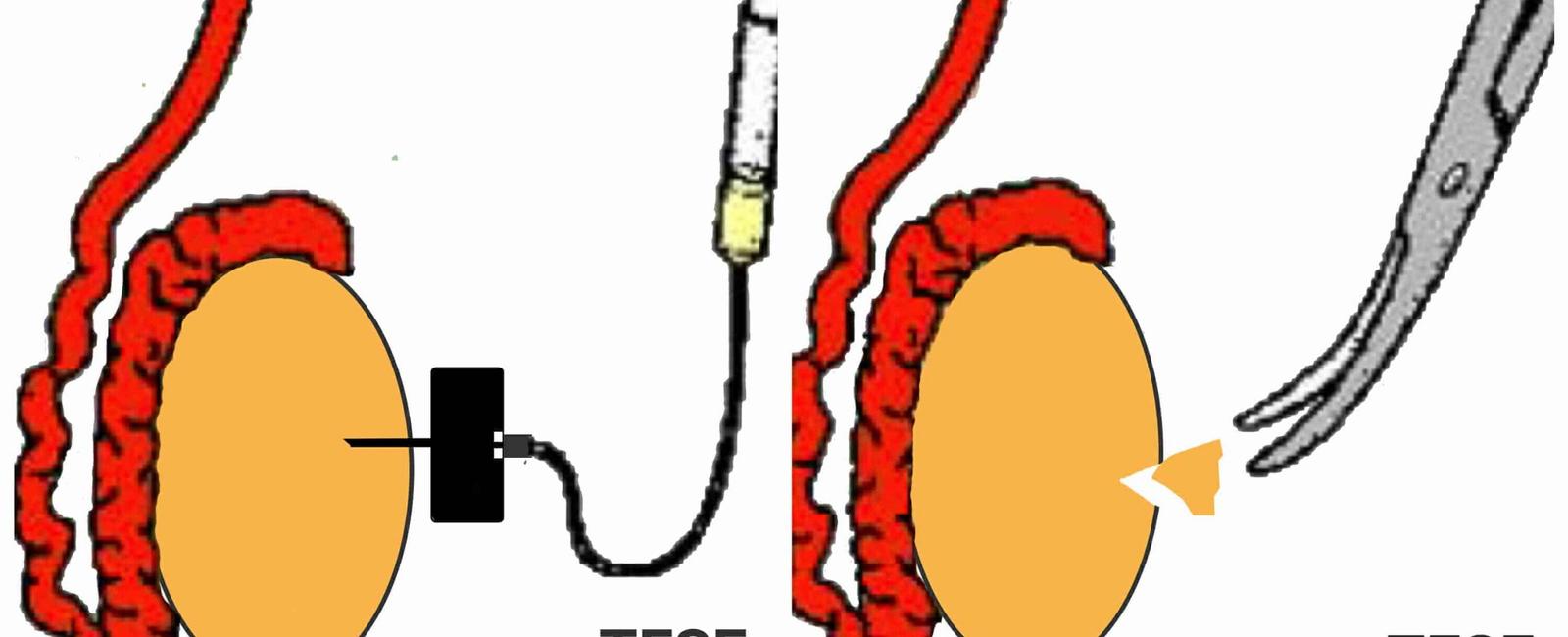 There is a new procedure that could restore male fertility by reimplanting frozen testicular tissue in order to obtain sperm for fertility treatments