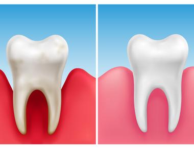 The mouth is the dirtiest part of the human body it contains over 700 types of bacteria