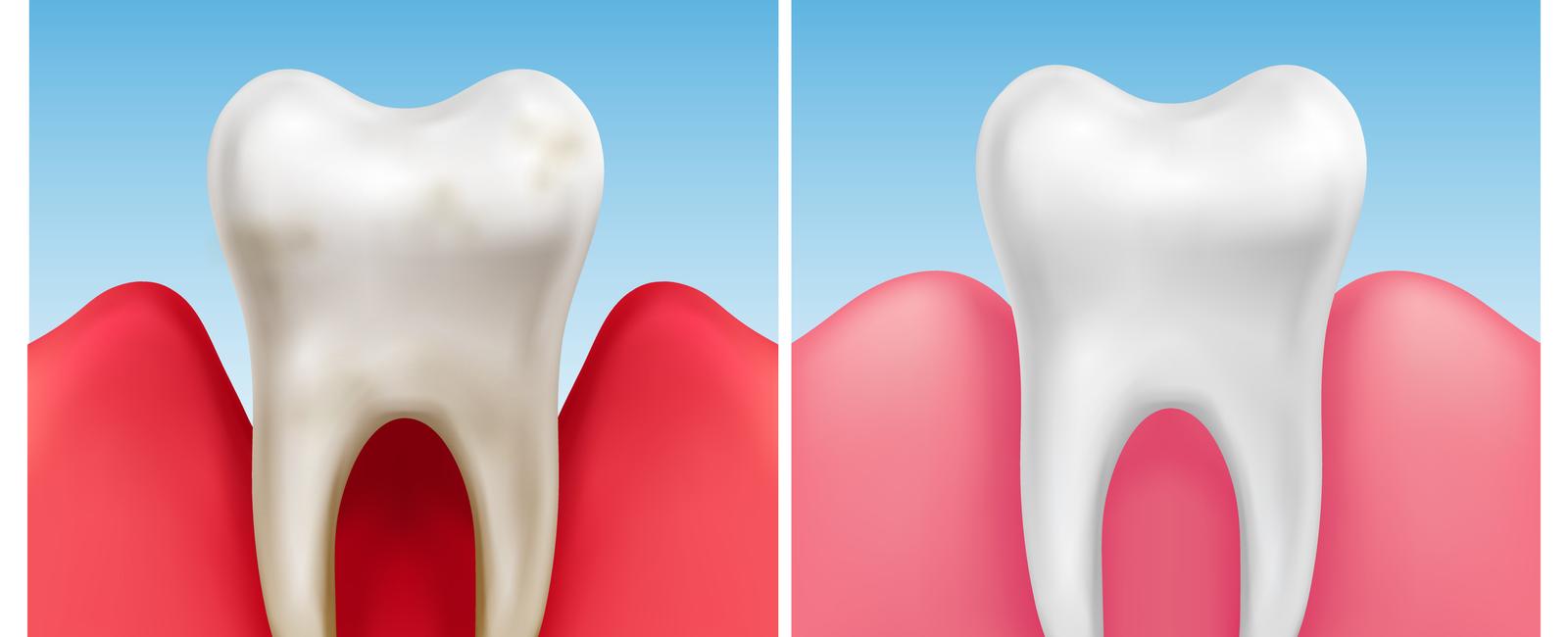 The mouth is the dirtiest part of the human body it contains over 700 types of bacteria