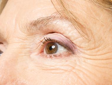 What are wrinkles around the eyes and mouth as the result of aging commonly called crow s feet