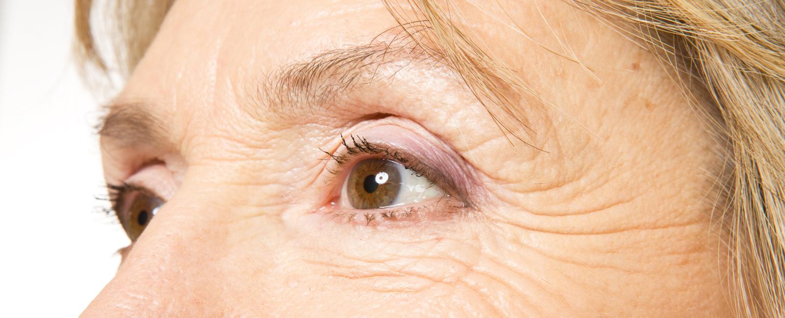 What are wrinkles around the eyes and mouth as the result of aging commonly called crow s feet