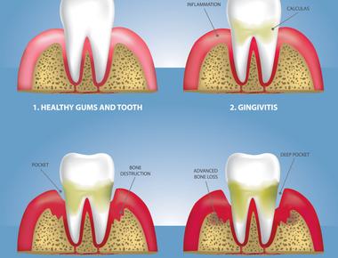 People who suffer from gum disease are twice as likely to have a stroke or heart attack