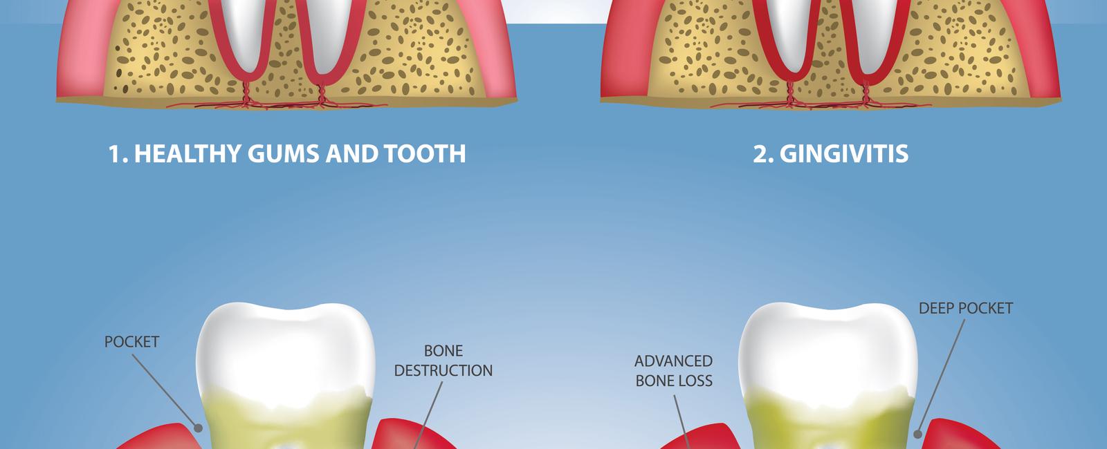 People who suffer from gum disease are twice as likely to have a stroke or heart attack