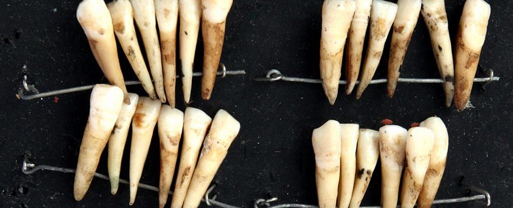 Before the 19th century dentures were commonly made with teeth pulled from the mouths of dead soldiers