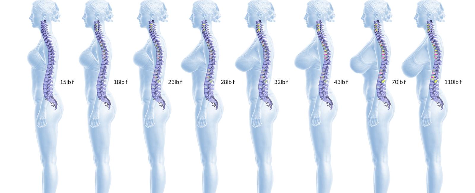 One female breast is usually 1 5 cup size larger than the other