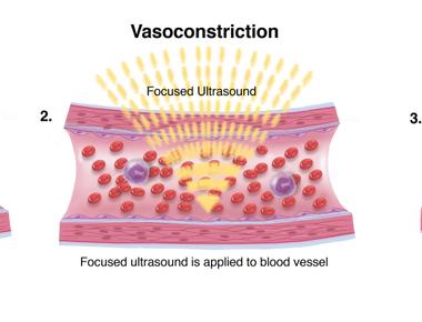 Digital vasoconstriction is the narrowing of blood vessels