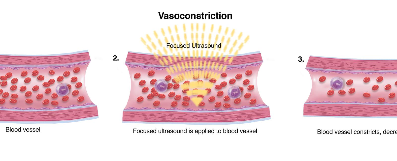 Digital vasoconstriction is the narrowing of blood vessels