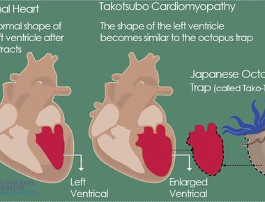 People die from broken hearts stress cardiomyopathy or broken heart syndrome causes sudden acute stress that quickly weakens the heart because of emotional and physical stress