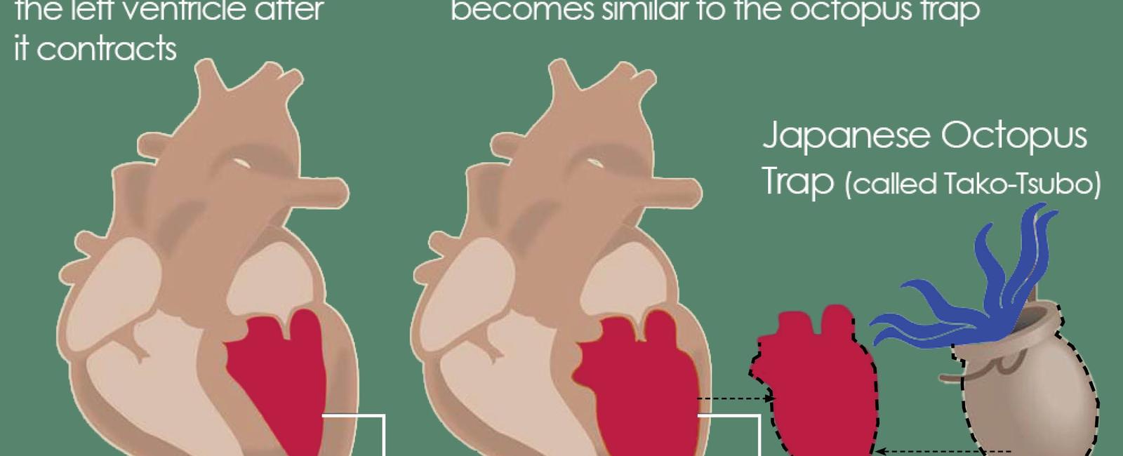 People die from broken hearts stress cardiomyopathy or broken heart syndrome causes sudden acute stress that quickly weakens the heart because of emotional and physical stress