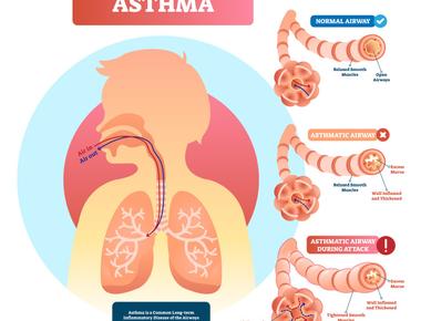 Asthma affects one in 15 children under the age of 18