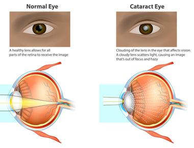 Sometimes the crystalline lenses of elderly people become milky and cloudy this is called a cataract and it causes partial or complete loss of vision