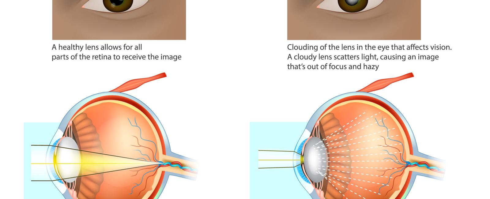 Sometimes the crystalline lenses of elderly people become milky and cloudy this is called a cataract and it causes partial or complete loss of vision