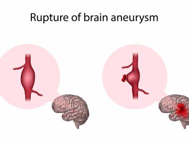 A brain aneurysm ruptures about once every 18 minutes