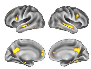 Researchers found pregnancy shrinks the brain s gray matter that contains the cell bodies and synapses of nerve cells