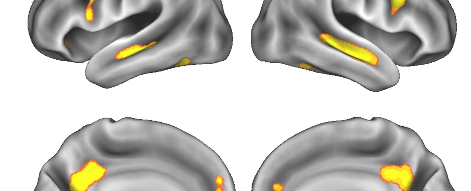 Researchers found pregnancy shrinks the brain s gray matter that contains the cell bodies and synapses of nerve cells