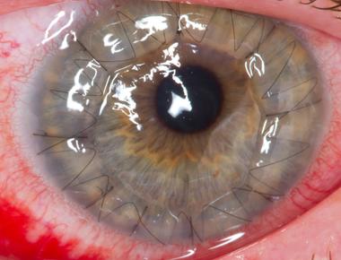 Shark corneas are used in human eye surgery as they are similar to a human cornea