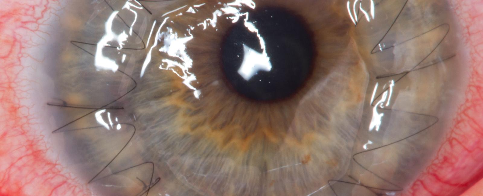 Shark corneas are used in human eye surgery as they are similar to a human cornea