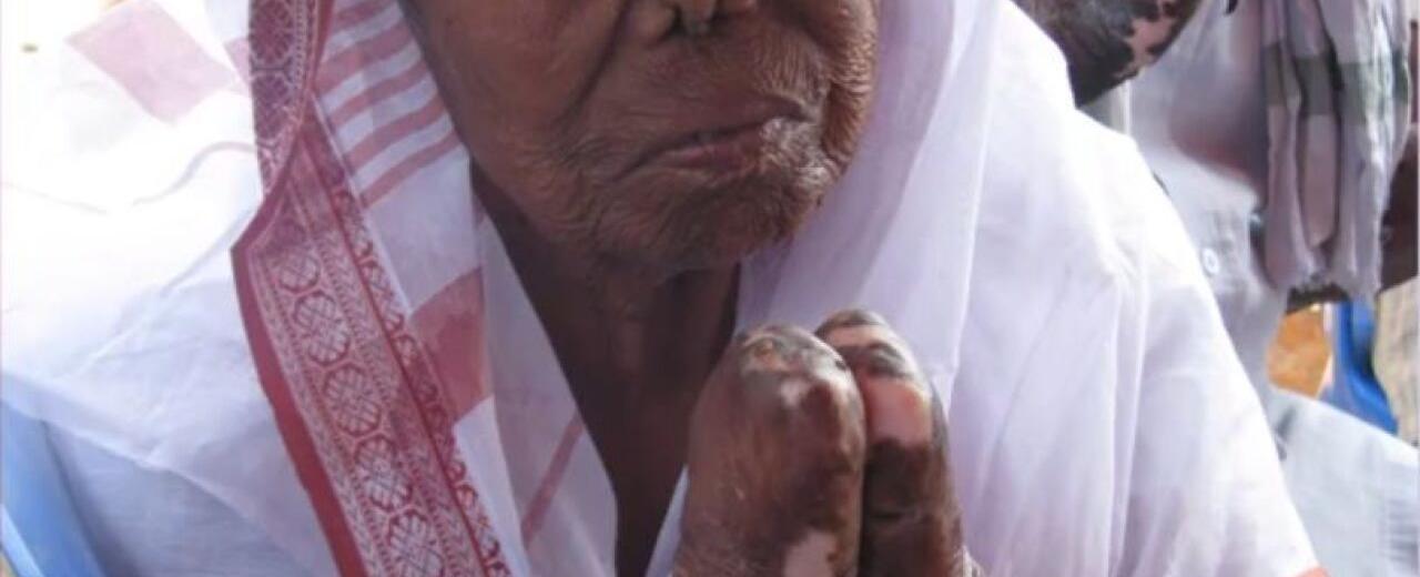 The oldest known disease in the world is leprosy