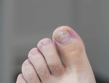 Ingrown toenails are hereditary