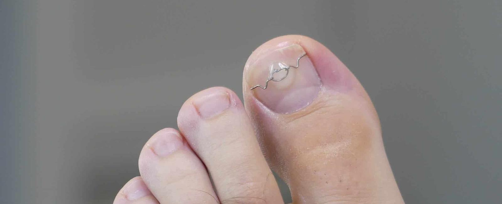 Ingrown toenails are hereditary