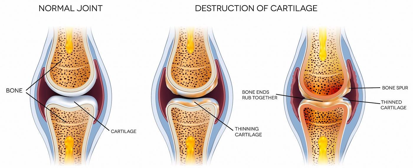 Arthritis causes joints to make sounds due to the loss of smooth cartilage and the newly formed roughness of joint surfaces