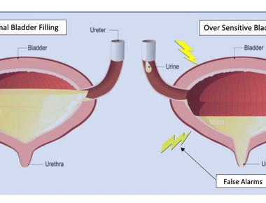 Causes dancing in children when it fills up bladder