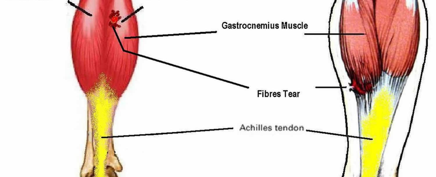 In the human body the muscle which can pull with the most force is the soleus which is found just below the gastrocnemius calf muscle it is vital for walking running and dancing