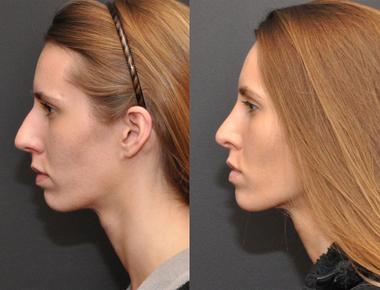 What body part is reshaped in plastic surgery known as rhinoplasty nose