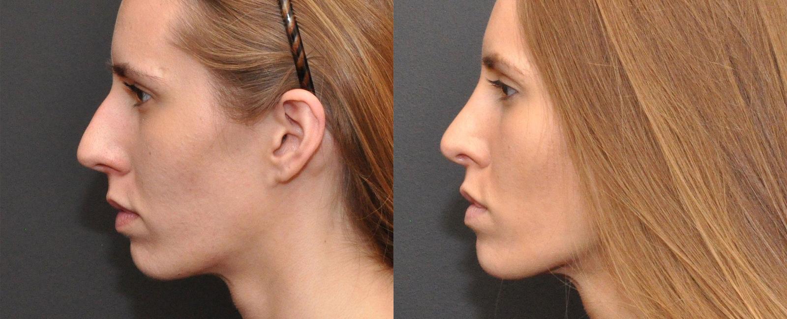 What body part is reshaped in plastic surgery known as rhinoplasty nose