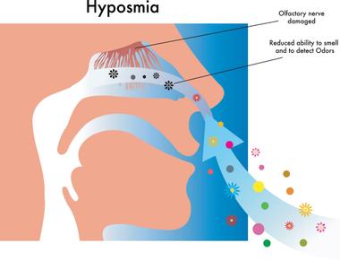 The complete loss of the sense of smell is called anosmia it also affects how you perceive the taste of food