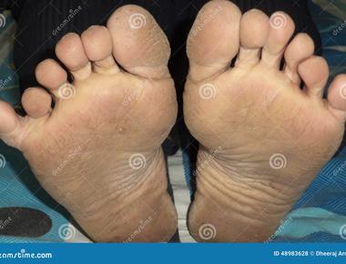 A person who is born with six fingers or six toes on one or both hands and feet is said to have hexadectylism