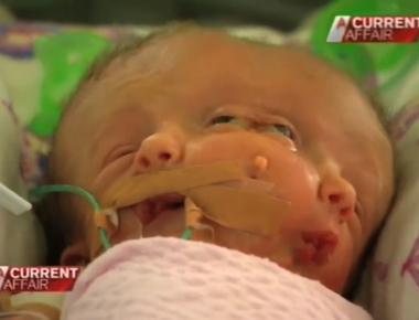 A baby was born in 2005 with a conjoined head that had no body the head could blink and smile