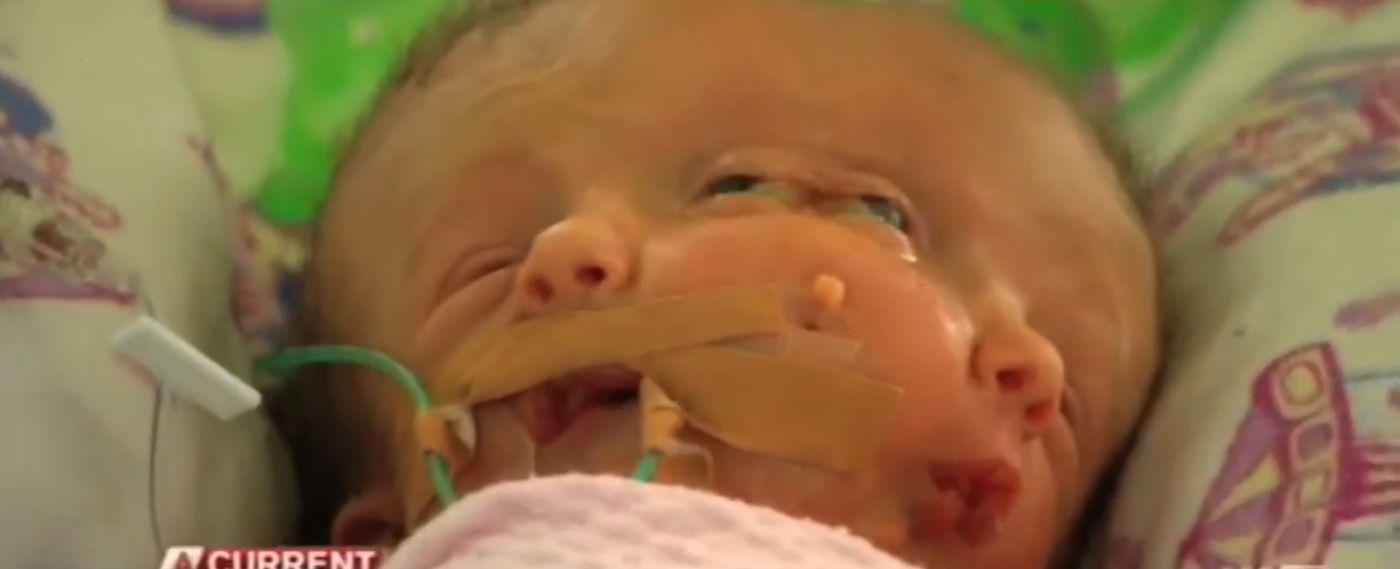 A baby was born in 2005 with a conjoined head that had no body the head could blink and smile